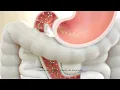 CREXONT carbidopa and levodopa extended-release capsules has transformed innovation into duration