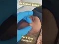 #cystremoval #blackheads #pimples #drkhaledsadek Dr Khaled Sadek Lipomacyst.com