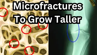 How To Grow Taller After Puberty: Full Microfracture Guide (with real-life examples)
