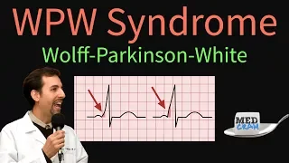 WPW Wolff Parkinson White Syndrome ECG EKG Findings Symptoms Pathology Treatment 