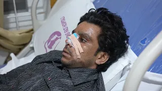 Indian Rhinoplasty for a Broad Nose | Complete Transformation
