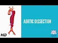 Aortic dissection AD Causes Signs and Symptoms Diagnosis and Treatment