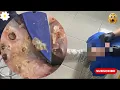 Extreme Jigger Infestation - Cracked Skin Peeled Off Clean