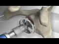 Shoulder Replacement Surgery Step-by-Step Arthroplasty