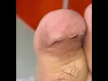 Download Lagu Ep_8114 Big ingrown toenail removal 👣 ตัดไปแล้ว..ทำไมเล็บยังแทงอีก 😄  (clip from Thailand)