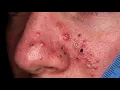Loan Nguyen Acne Treatment 25zz