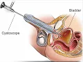 Cystourethroscopy with biopsy CPT code - simplify medical coding