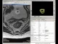 Iterative-Cuts Interactive Rectum Segmentation under the medical prototyping platform MeVisLab
