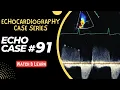 ECHO CASE 91 Echocardiography for Beginners Echocardiogram Interpretation 2D Echo Basics