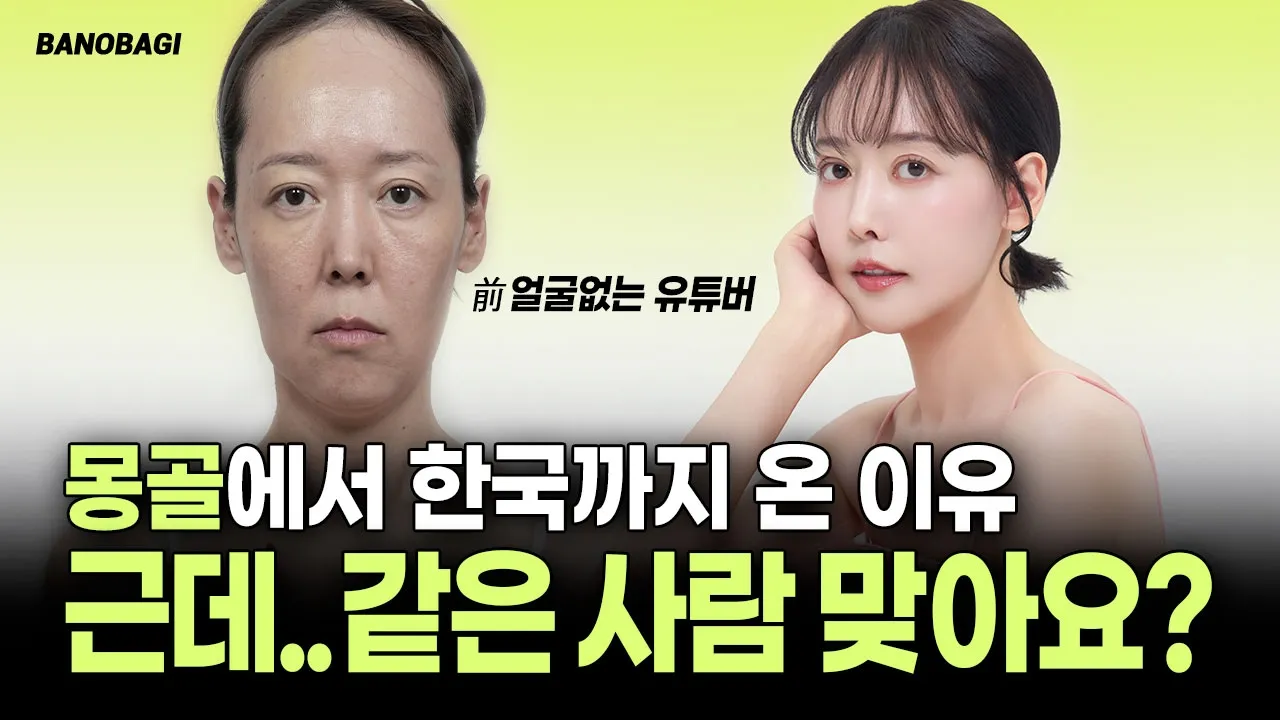 몽골 얼굴없는 유튜버 수술로 자신감 회복🔥 I 이마거상 + 이마축소+ 눈밑 지방재배치 + 안면거상 + 윤곽수술 + 아테콜 필러 + 모티바 프리저베 수술 후기💛