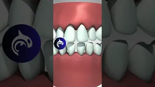 Cavity And Gum Disease 3D Animation Dentalhealth 