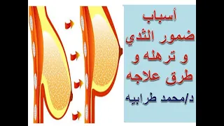 أسباب ضمور الثدي و ترهله و كيفية علاجه   دكتور محمد طرابيه دندنها