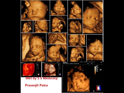 Download MP3 How To Get Perfect 3D/4D Baby Image By Ultrasonography System ( by Mindray )