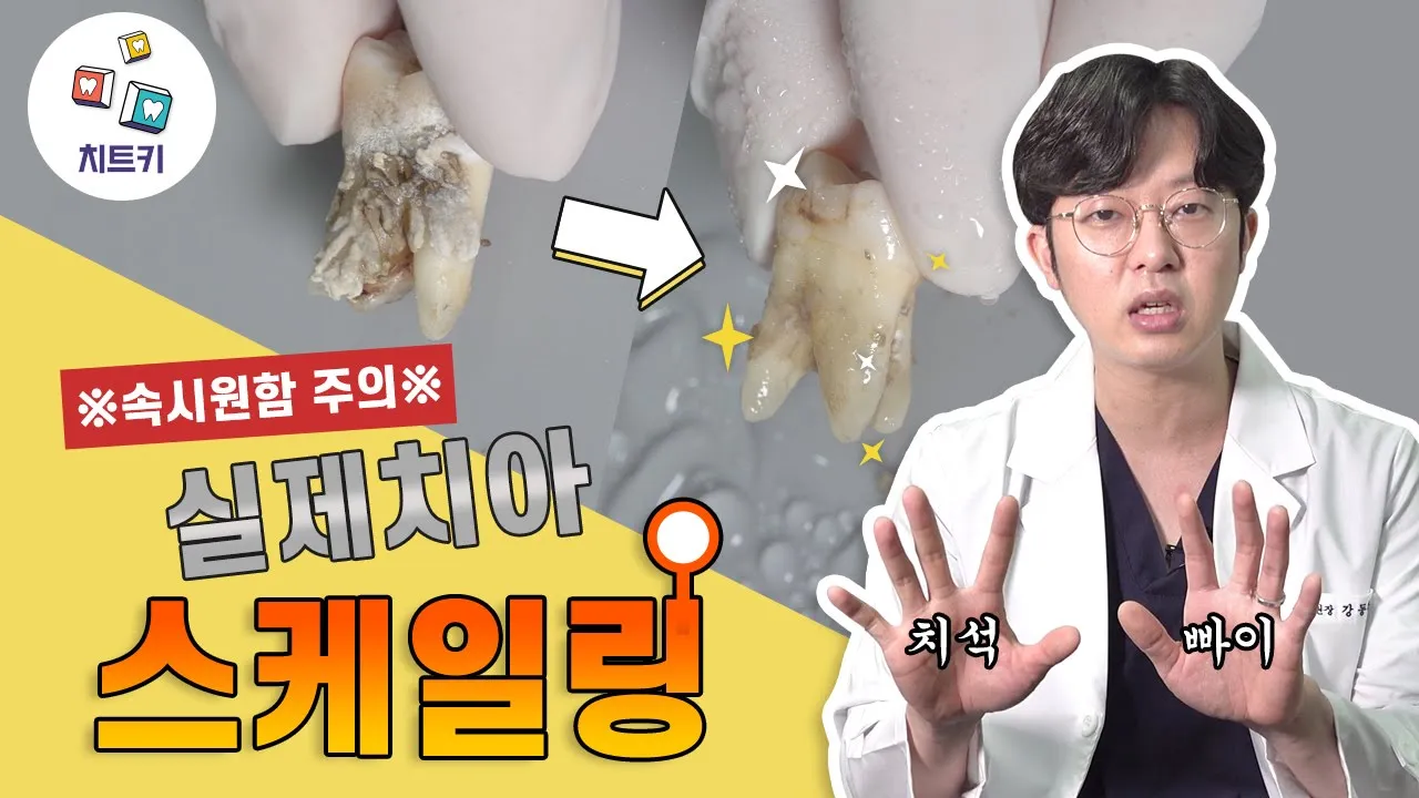 ※속 시원함 주의※ 스케일링, 이렇게 진행됩니다! 실제 치아 치석제거 과정 대공개! 스케일링 후 주의사항까지😎