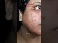 Download Lagu Cystic Acne Recovery in PCOS | Acne Treatment \u0026 Cure | PCOS PCOD Breakouts | Purging | Disha Ghosh