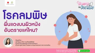  โรคลมพิษคืออะไร และเกิดจากสาเหตุใดบ้าง 