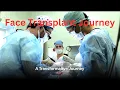 The Transformation Katie Stubblefield s Face Transplant Journey