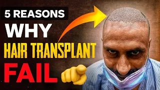 Never Do 5 Mistakes in Hair Transplant 2024 | Hair Transplant Results