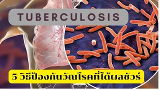 วัณโรคเกิดจากเชื้ออะไร และมันมีลักษณะพิเศษอย่างไร