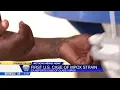 First known case of emerging Mpox strain has been detected in California