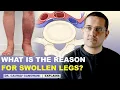 Download Lagu Swollen feet | Ankle swelling | Leg swelling | May Thurner syndrome | Dr. Gaurav Gangwani