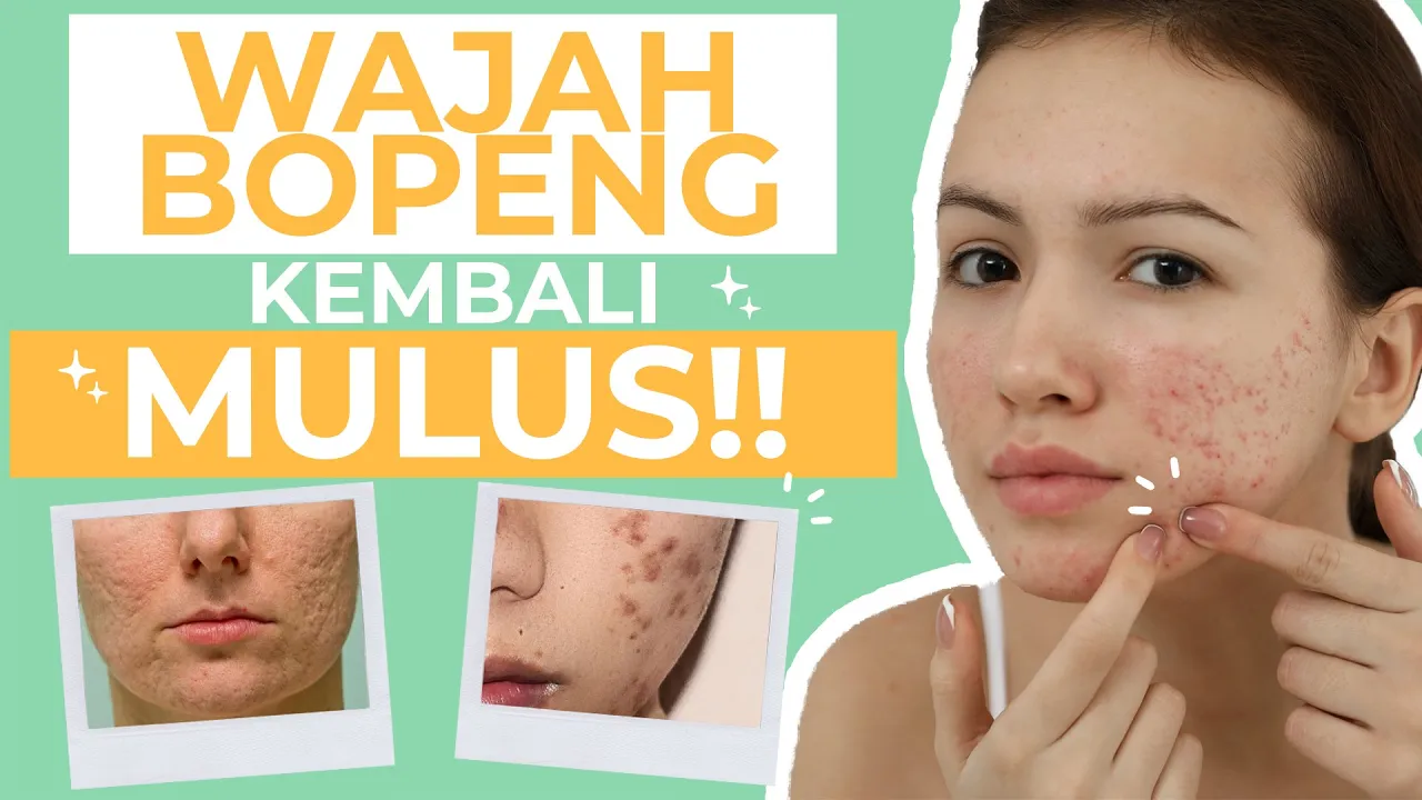 
          
          
          
            
            Murah Meriah! 5 Cara Menghilangkan Bopeng Bekas Jerawat Alami dan Cepat!
          
        . 