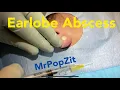 Large Earlobe Abscess with surprising amounts of discharge and sac expressed