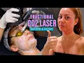 Most Powerful Anti-Aging Laser My Fractional CO2 Laser Review Before After