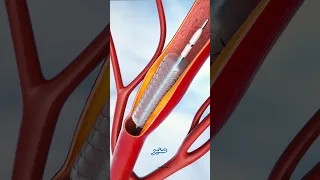 قسطرة القلب 