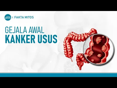 Waspada! Kembung Bisa Jadi Gejala Awal Kanker Usus