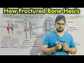 Fracture Healing Process Repair of Fractured Bone