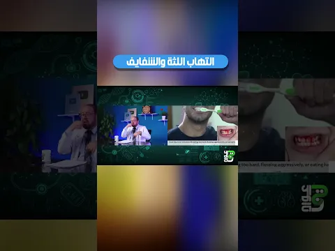 التهاب اللثة🌟 والشفايف