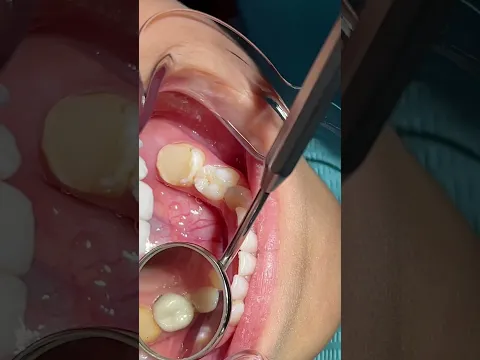 تلبيسات الأسنان التجميلية(zircon crowns )😄👧 ، #smile #kidsdentist   #اكسبلور #dentistry #dentist