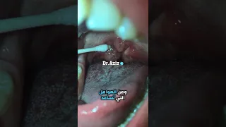 كيف تتكون حصى اللوزتين 