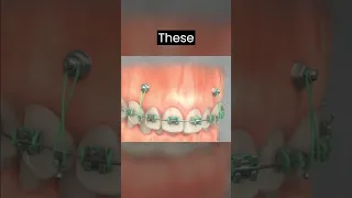 TADs 3 The next level Orthodontic treatment technique