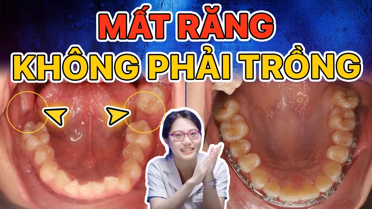 Outline Video Mất Răng 6, 7 Không Cần Trồng Lại Vẫn Đều Đẹp - Giải Pháp Là Gì? Tung Chứng Cứ Rõ Ràng!