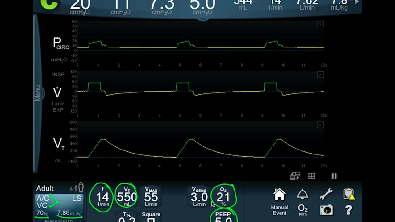 Ventilator Modes Explained: Volume, Pressure, PS | UCSF
