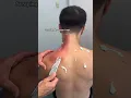 Scraping the upper traps