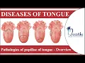 Diseases of tongue Pathologies of papillae of tongue - Overview Tongue diseases Oral Pathology