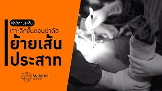 ทำไมถึงต้องใช้เส้นประสาทจากแขนข้างหนึ่งมาต่อที่คอเพื่อช่วยฟื้นฟูการเคลื่อนไหวของมือ?