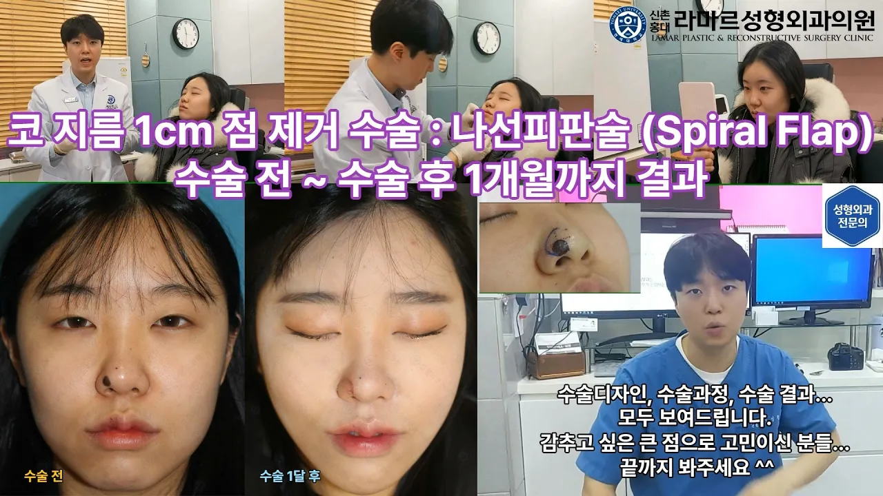 21세 여성 코 지름 1cm 점 제거수술 : 나선피판술(Spiral Flap) 수술전~1달 경과. Feat. 턱끝필러+사각턱 보톡스