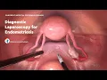 Diagnostic Laparoscopy for Endometriosis