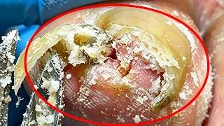Patient Close To 90 Years Old With Osteoarthritis Plus Visual And Motor Difficulties  Podology