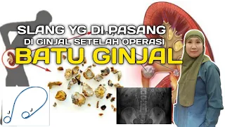 prosedur pemasangan jj stent setelah operasi batu ginjal