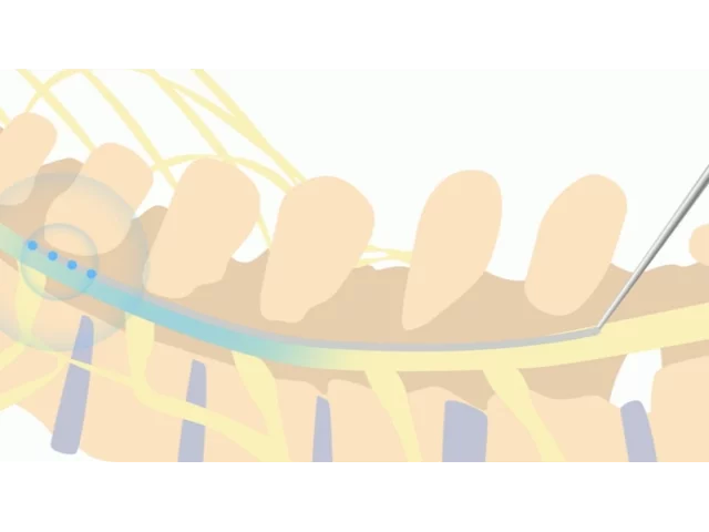 Animation of Spinal Cord Stimulator Implant Procedure