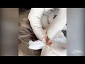 Download Lagu Extracting a Pilar Cyst (Pilar Cysts Can Haunt Your Scalp) | CONTOUR DERMATOLOGY