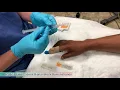 Digital Block - How to Minimize Pain during the Procedure