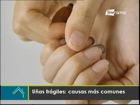 Uñas frágiles: Causas más comunes