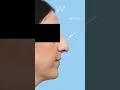 Before and after results Rhinoplasty procedure to smooth down her dorsal hump and lift the tip
