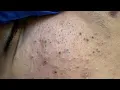 ASMR Satisfying Blackhead Removal Deep Pore Cleansing Techniques